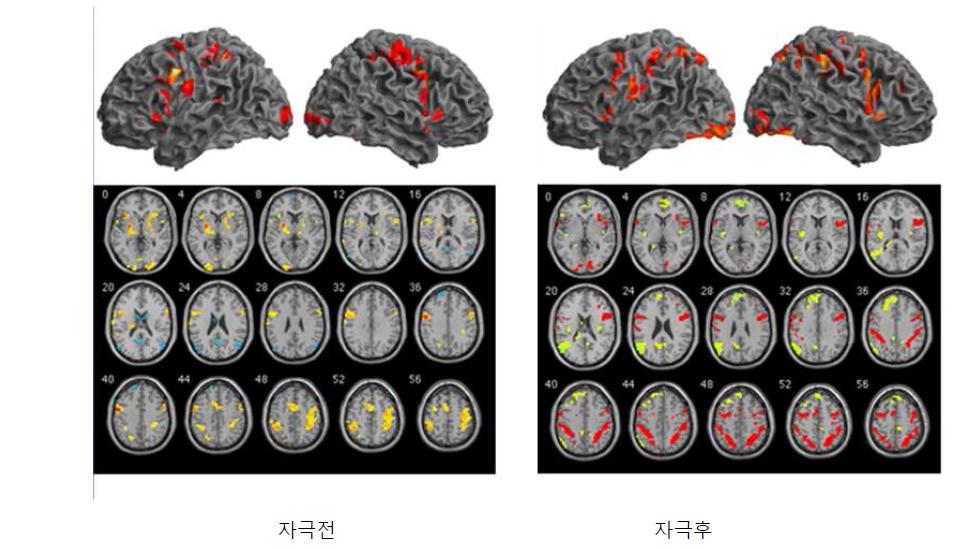 누적복합자극 전(왼쪽)과 후(오른쪽)의 왼손 sequential motor task 수행과 관련된 뇌 영역의 활성화 양상