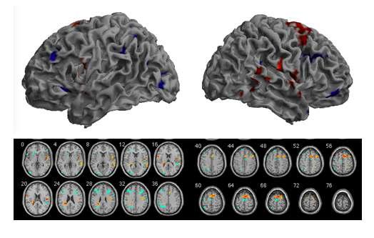 왼손 sequential motor task 수행과 관련된 뇌 영역의 누적복합자극 전후 활성화 차이(p 10 voxels). red blob: 자극 후>자극 전, blue blob: 자극 전> 자극 후