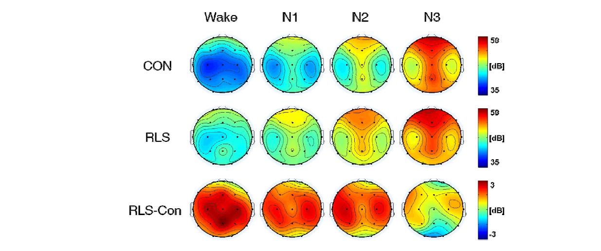 델타 대역에서 정상 대조군과 RLS 환자군의 수면 단계에 따른 파워 스펙트럼의 두피면 상 분포