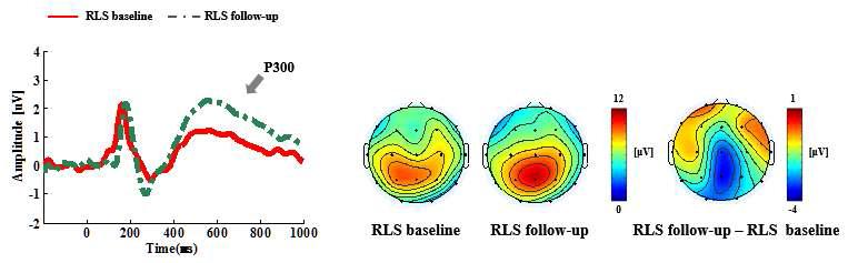 ERP 약물치료 전/후의 (좌) 두Pz피 전면극상에 분서포의도 ERP 파형 및 (우) P300 시간구간에서의 두피면상 분포도