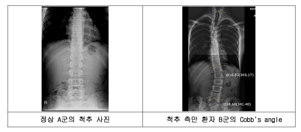 척추 X-ray 사진 예