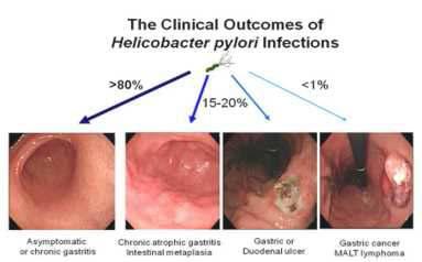 H. pylori)에 의한 위염, 위암 발병 가능성