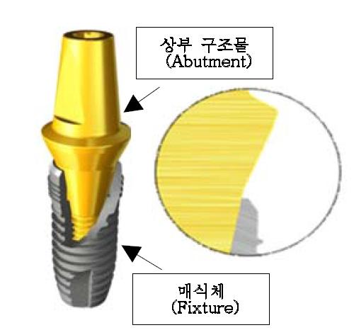 매식체(Fixture)와 상부 구조물(Abutment)의 체겨체