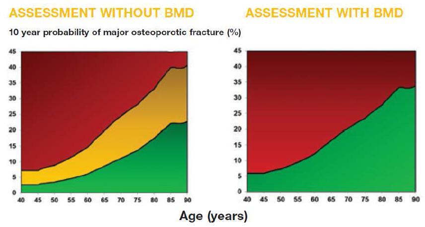 골밀도 검사 없는 경우와 골밀도 검사를 하는 경우에서의 골절위험도 및 치료 평가