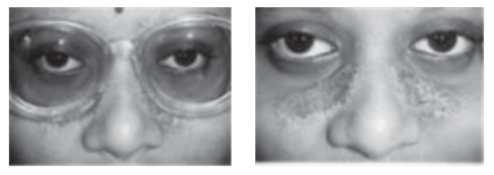 플라스틱 안경테로 인한 접촉성 피부염