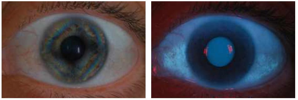 UV손상 촬영이 가능한 특수카메라로 찍은 전안부(좌–안구의 코와귀쪽에 UV손상