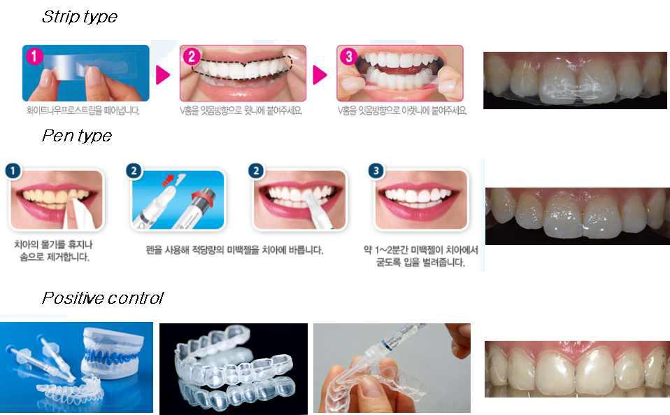 (in vivo) 치아미백제 적용