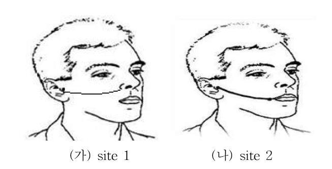 안면 신체계측 영역 (가) site 1 (tragus에서 alar-facial groove까지 잰 길이) (나) site 2 (tragus에서 mouth corner까지 잰 길이)