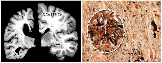 Pathology of Alzheimer's disease(AD)