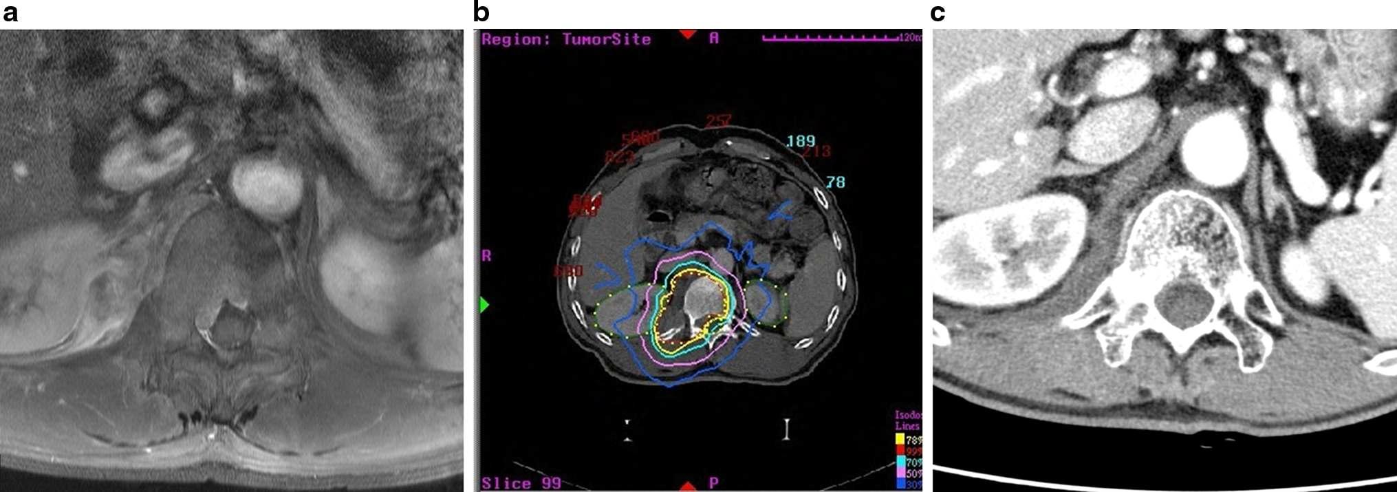 a : 47-year-old male patient was diagnosed as T12, L1 metastatic tumor from hepatocellular carcinoma. He suffered from back pain and intercostal neuralgia. a MRI axial image taken at T12 level showed large mass involving right side vertebral body, right side diaphragm and spinal canal. b : Radiosurgery plan; the volume of tumor was 200 cc. Tumor margin dose was prescribed as 36 Gy in 4 fractions. The total covered tumor volume was 96%. Radiation dose in spinal cord was 29.5 Gy in maximum and 18.5 Gy in minimum with 4 fractions. c : At post-radiosurgery 6 months, follow-up CT showed mass shrinkage and spinal cord decompression.