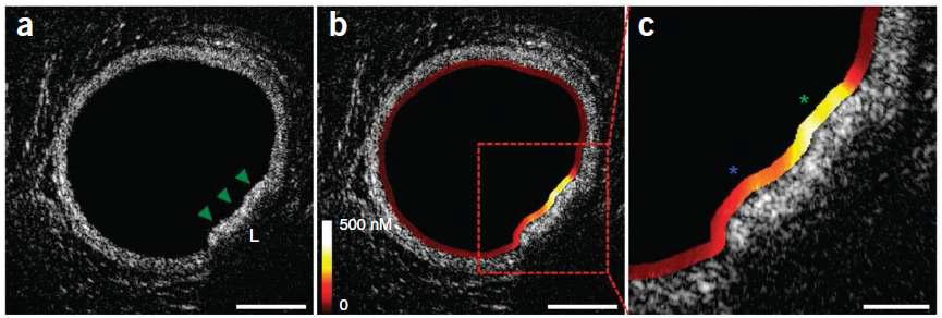 Dual-modality OFDI-NIRF images of atherosclerosis in a living rabbit.