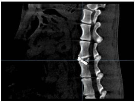 수술 위치 확인 (Sagittal View)