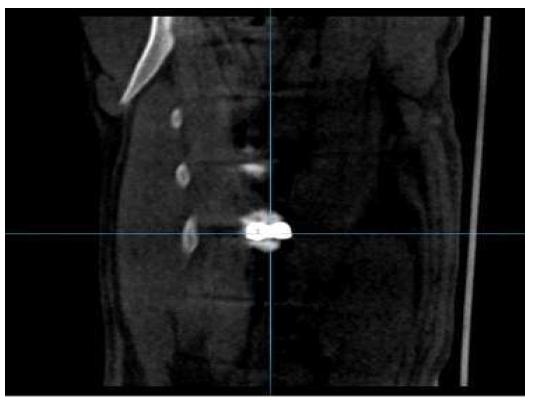 수술 위치 확인 (Coronal View)