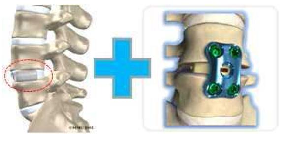 Cage와 Ti Plate를 이용한 시술