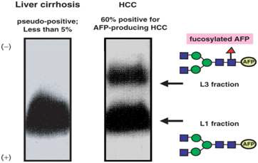간암에서 AFP-L3의 진단 유용성