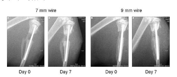경골 골수강정 삽입 직후 및 1주일 후 손상부위가 유지되는 지 X-ray로 확인.