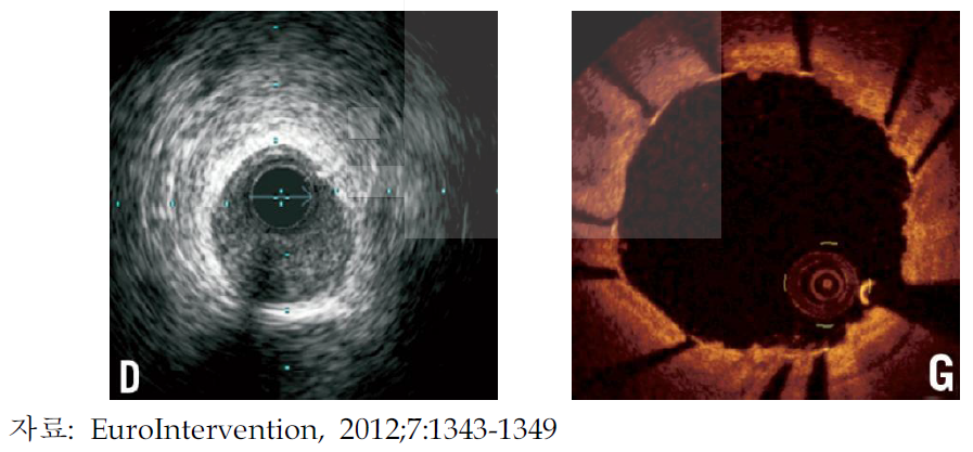 심혈관의 IVUS(왼쪽)와 OCT(오른쪽) 영상