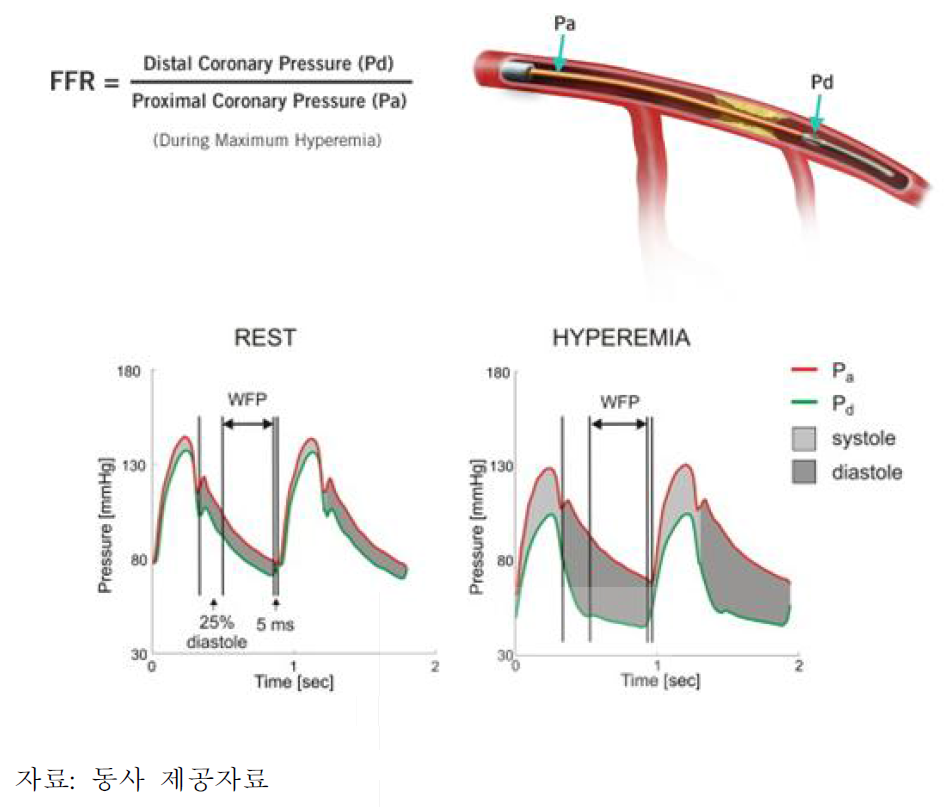 FFR 및 iFR의 측정 모식도