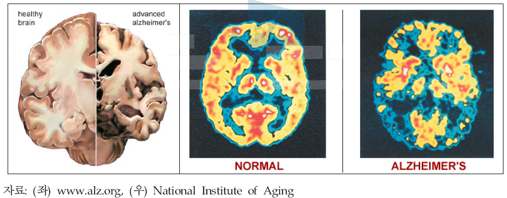 건강한 사람과 알츠하이머병 환자의 뇌구조 비교