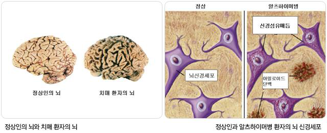정상인과 알츠하이머병 환자의 뇌 비교
