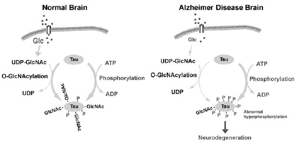 정상(좌)과 알츠하이머병 환자(우)의 뇌 속에서 일어나는 Tau의 변화(O-GlcNAcylation/phosphorylation) 모식도