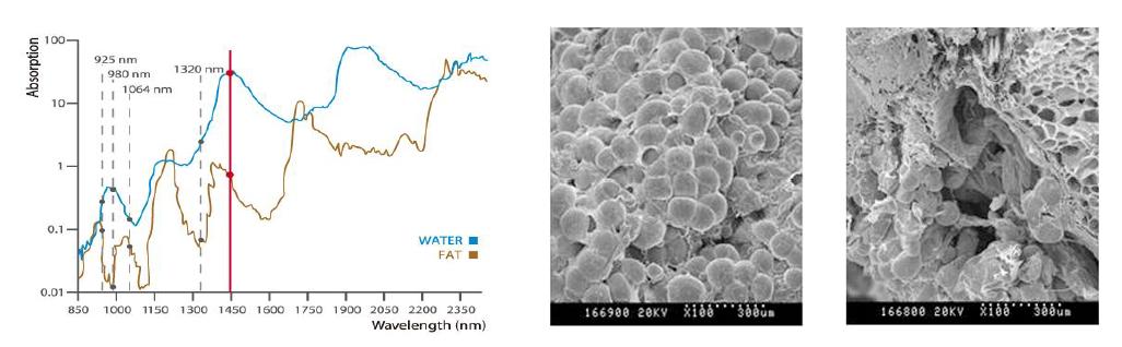 파장별 물과 지방에 대한 흡수율 (左), 1450 nm 파장의 레이저빔 조사 후 인체지방조직 변화 (右)