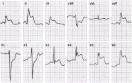 ECG gram