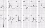 ECG gram