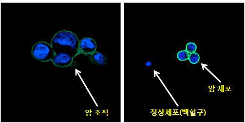 암조직과 정상세포의 구별 영상