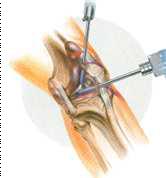 관절경 진단 및 수술 방법