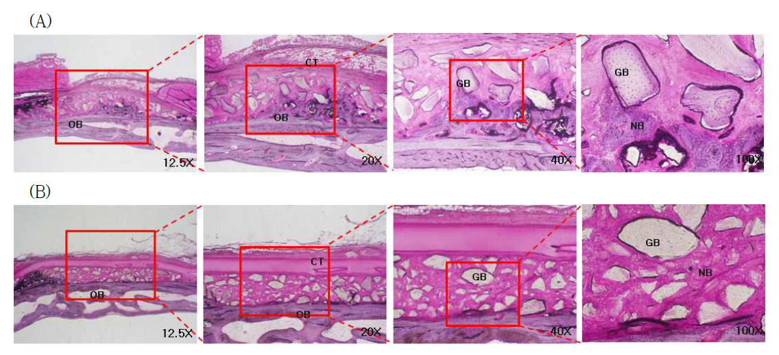 4주 후 골증강 기능성 펩타이드가 도입된 바이오소재를 이식한 토끼 두개골 결손부의 조직학적 결과. (A) 펩타이드가 도입된 바이오소재 (B) 바이오소재. OB: 기존 골 (orinigal bone), GB: 이식된 골 (Grafted bone), NB: 새로운 골 (New bone), CT: 결합 조직 (Connective tissue)