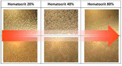 헤마토크릿에 따른 적혈구의 분포 정도