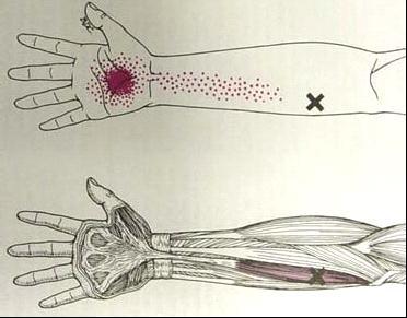 장장근(Palmaris Longus)의 위치