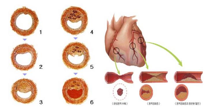 동맥경화반의 진행 모식도(왼쪽)와 동맥경화와 수반된 혈전(오른쪽)