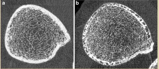 폐경 후 골절이 없는 여성 (a) 과 골절이 있는 여성 (b)에서 HR-pQCT 로 경골 (tibia)을 촬영한 이미지