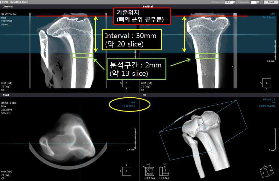 경골의 ROI선정