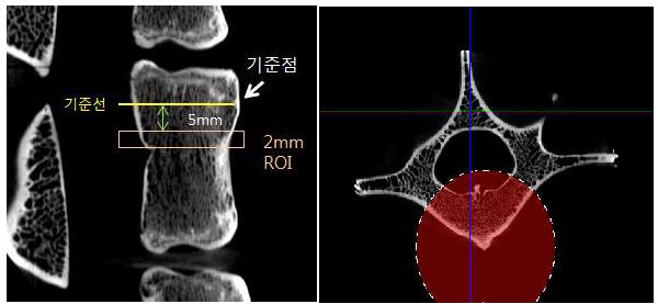 요추의 ROI선정