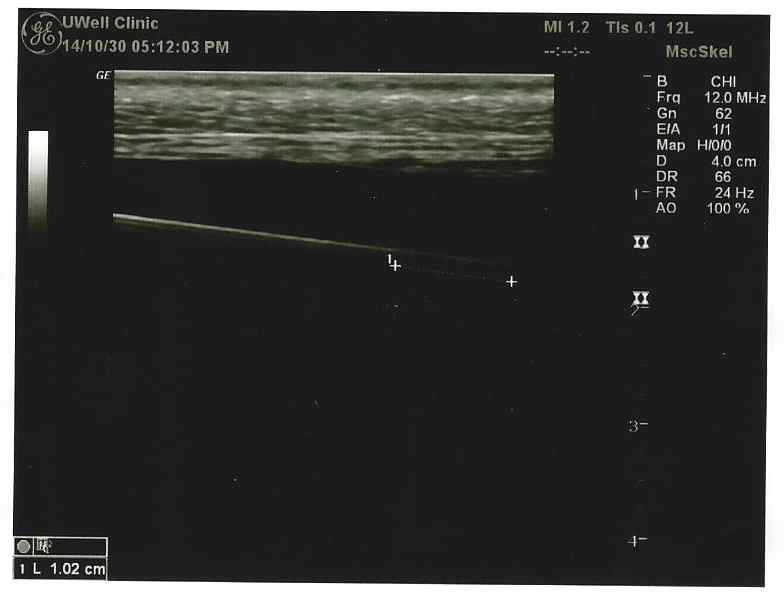 초음파상의 Needle