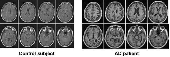정상인 (좌)과 Alzheimer 환자 (우) 뇌의 MR 영상