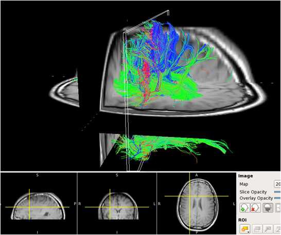 DTI 기법으로 얻은 뇌의 신경섬유 MR 영상