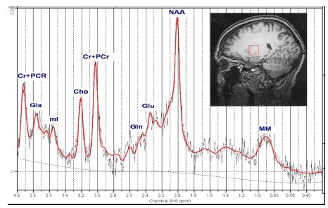뇌 특정 부위의 localized MR spectrum