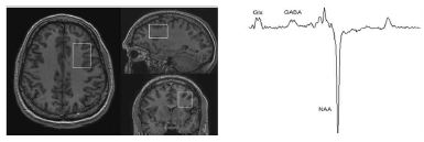 뇌영상(좌)과 박스부위에서 MEGA-PRESS sequenc를 사용하여 얻은 GABA 및 Glutamate peak