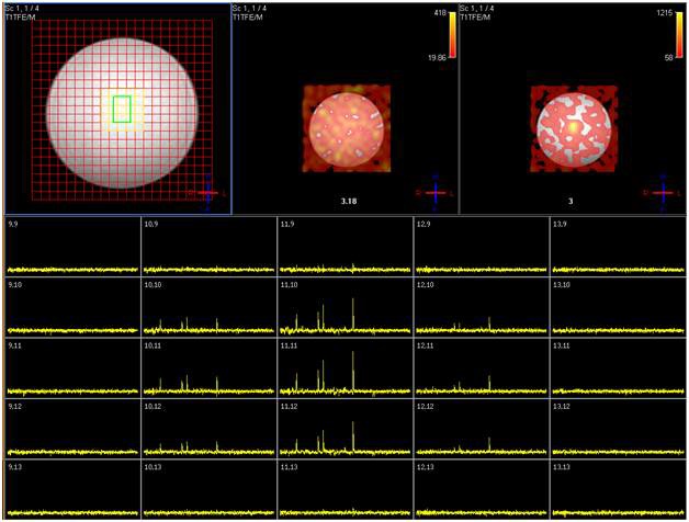 (좌상) MRI 영상에 overlay된 MRSI 선택 grid, (중상) random undersampling을 구현한 pulse sequence로 얻어진 2D MRSI 영상 (Cho map), (우상) Cr map, 그리고 (하) 2D MRSI spectra display결과로 undersampling이 3T MRI상에서 문제 없이 구현되는 것을 확인