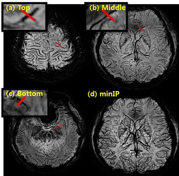 7T MRI에서 획득한 SWI영상, 뇌의 위(a), 중간(b), 아래(c), 여러 슬라이스뇌영역의 혈관을 한 평면에 프로젝션(d)