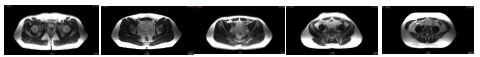 3.0T MRI를 위한 32 Channel Torso/Cardiac 전용 RX RF코일의 In vivo 영상, 5 slices
