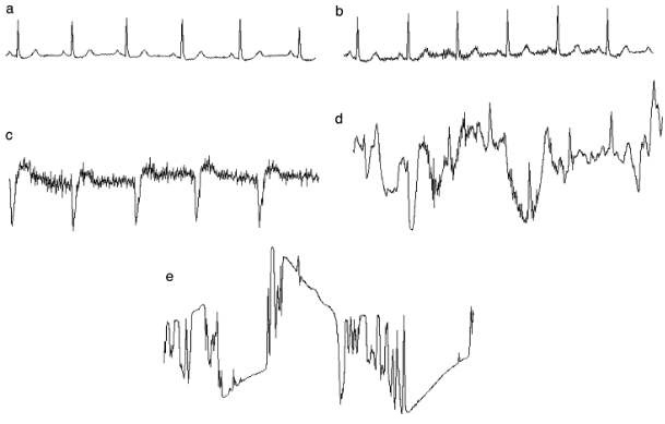 그림 29 해당 논문에서 제시한 5단계의signal quality. 0에서 5로 이동할수록 noise level이 심해짐.