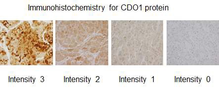 Figure 5. Examples of immunohistochemistry for CDO1 protein in HCC tissues. Tissues are graded by the intensity of staining of the protein.