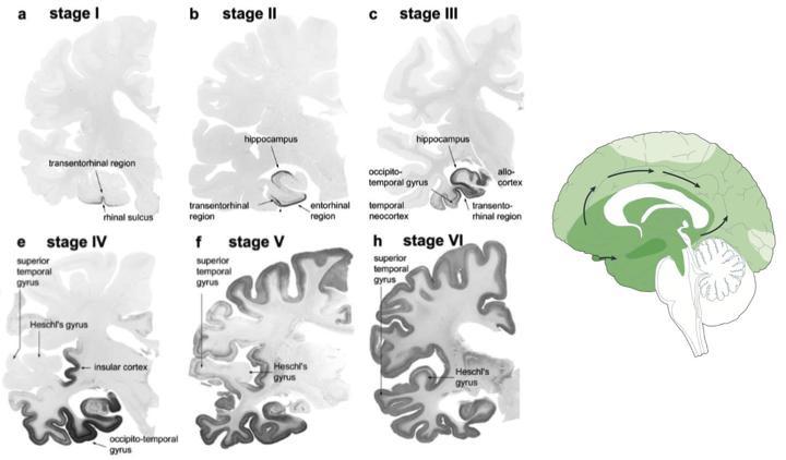 알츠하이머 환자 뇌에서 Neurofibrillary tangles이 시작 및 확산되는 정도를 나타낸 병리학 사진 및 모식도.