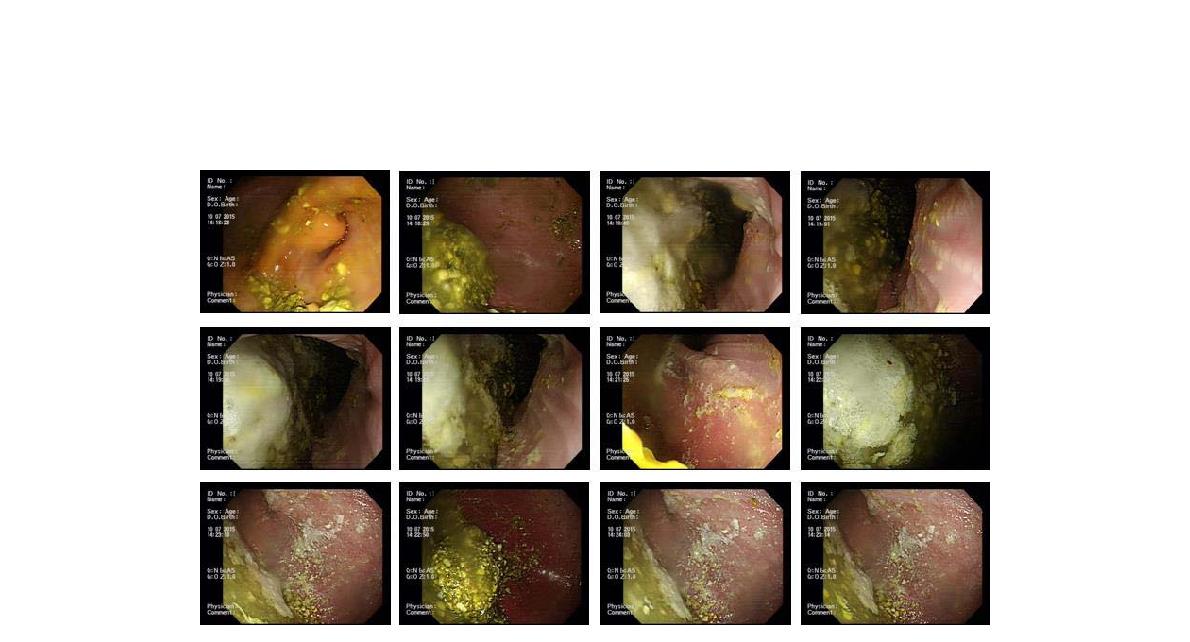 Gastric distribution of the S-calcium in No.1 mini pig. The S-calcium was dissolved in distilled water at dose 3g/20mL, and orally administrated with gavage. Thirty minutes after treatment, the distribution of the S-calcium was analyzed by gastric endoscopy. Some whitish aggregates were found at proximal body of the stomach.