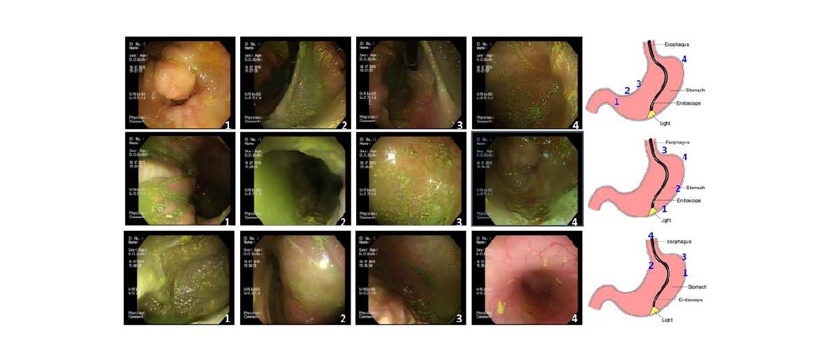 Gastric distribution of the S-gentamicin (S-GM) in No.2 mini pig. The S-GM (with 10% indigocarmine) was dissolved in D.W. at dose 3g/20mL, and orally administrated with gavage. One hour after treatment, the distribution of the S-GM was analyzed by gastric endoscopy. Greenish colored S-GM was diffusely coated at gastric body area.